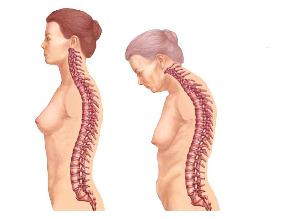 Здоровый изогнутый позвоночник с остеохондрозом